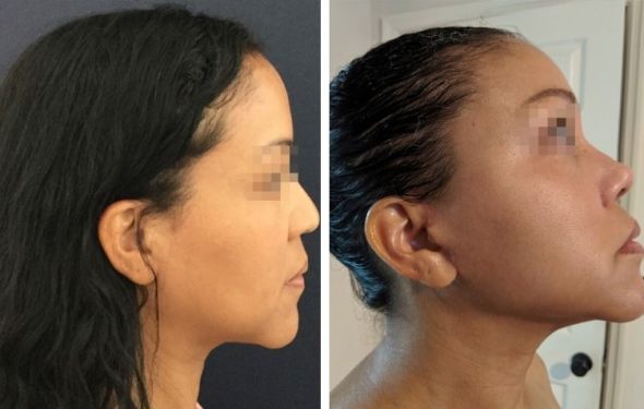 deep plane facelift colombia - premium care plastic surgery