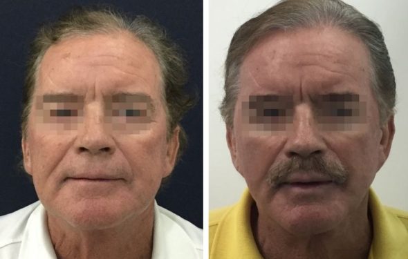 deep plane facelift colombia - premium care plastic surgery