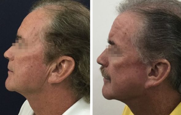 deep plane facelift colombia - premium care plastic surgery