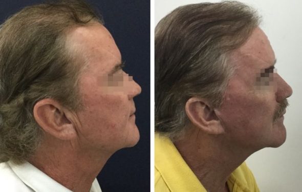 deep plane facelift colombia - premium care plastic surgery