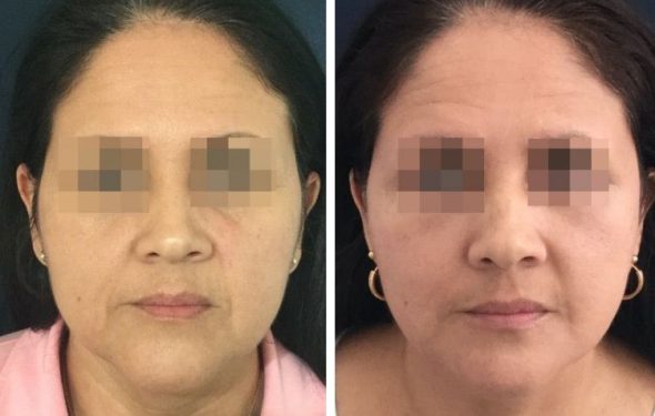 deep plane facelift colombia - premium care plastic surgery