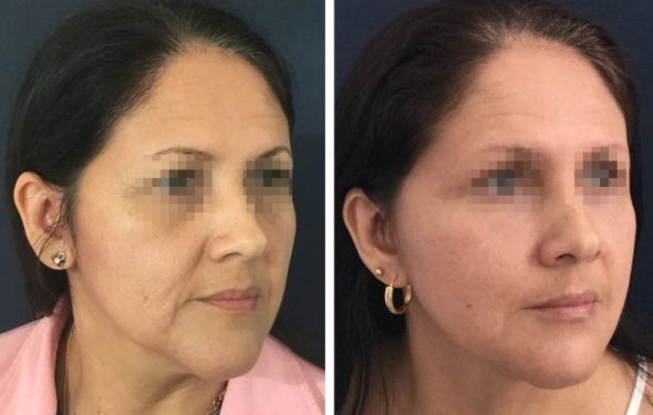 deep plane facelift colombia - premium care plastic surgery