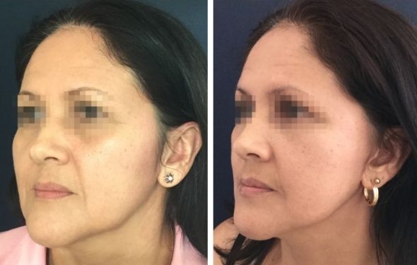 deep plane facelift colombia - premium care plastic surgery