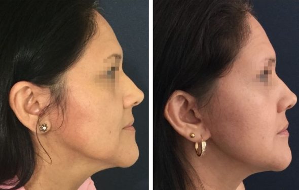 deep plane facelift colombia - premium care plastic surgery