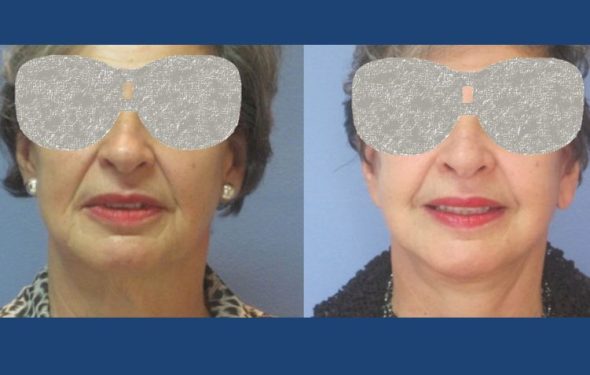 Facelift Colombia - Premium Care Plastic Surgery