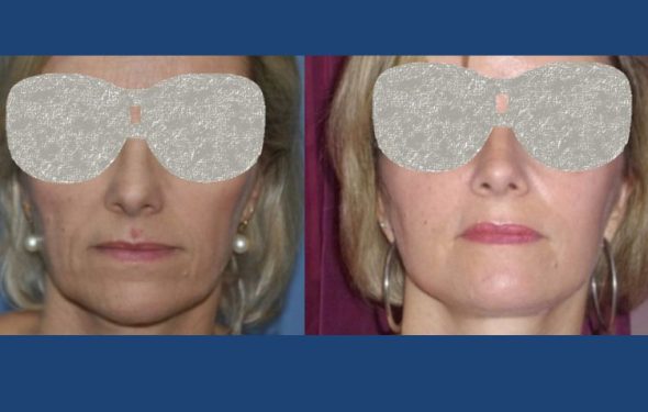 Facelift Colombia - Premium Care Plastic Surgery