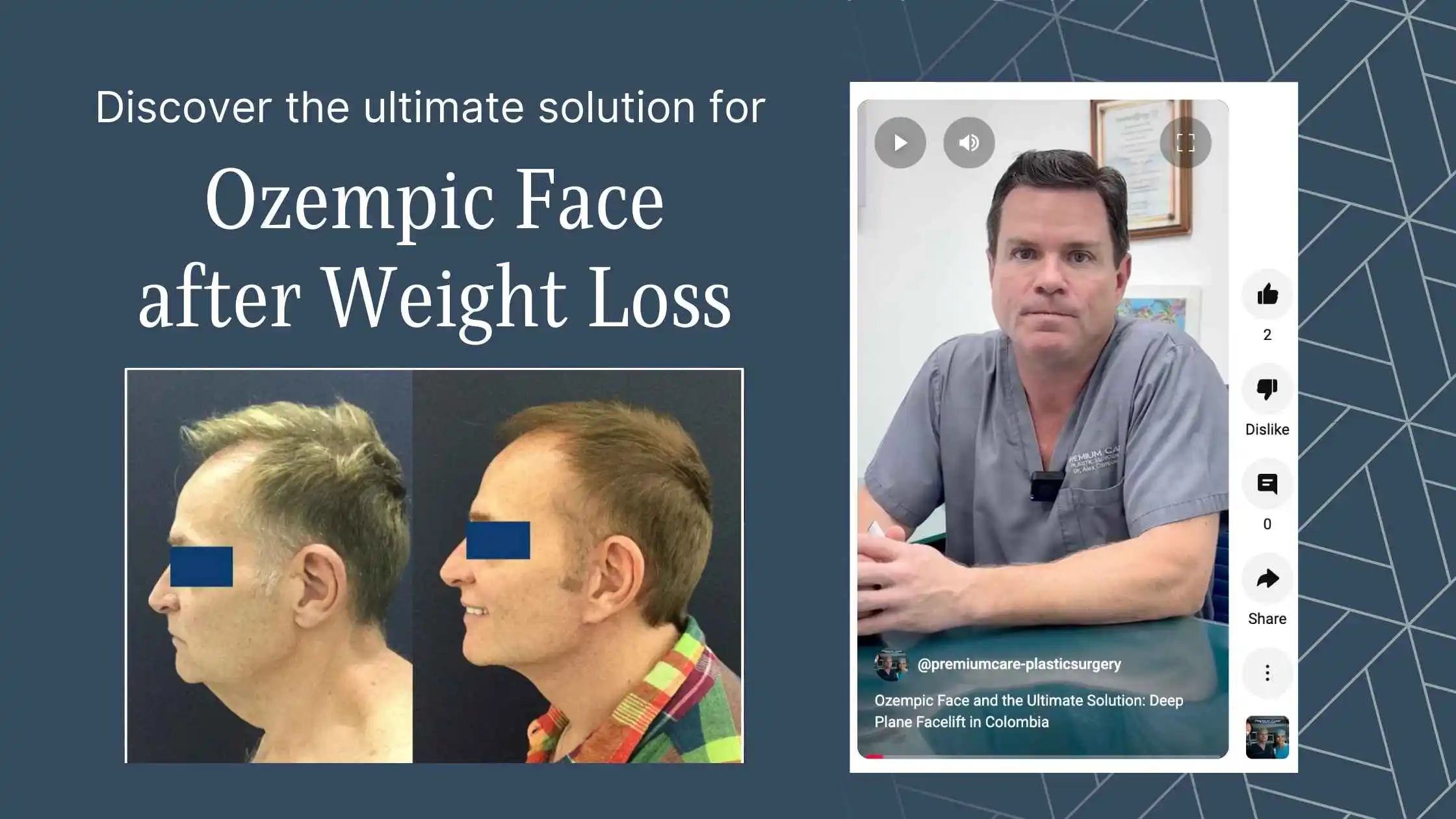 ozempic face solution - deep plane facelift in Colombia