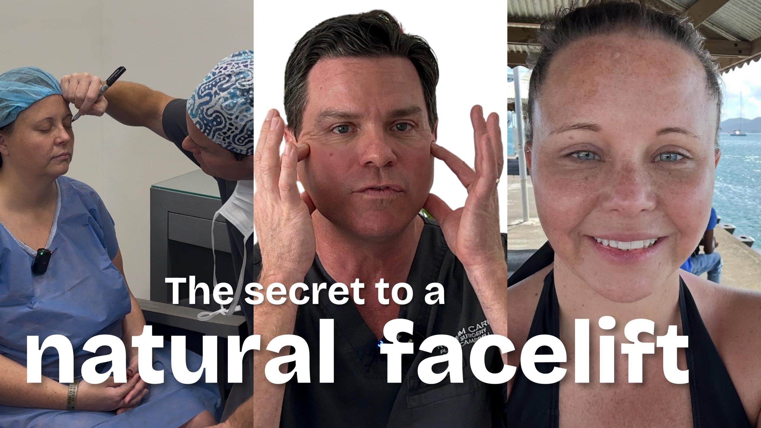 Secret for a natural facelift - premium care plastic surgery