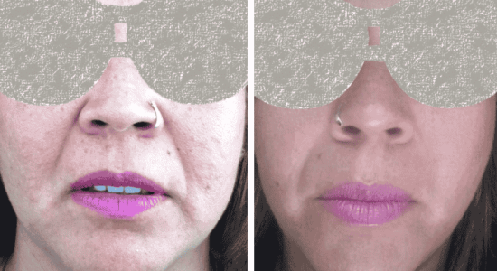 facelift before and after 590 x 375
