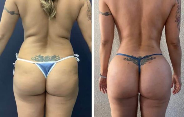 BBL—Brazilian butt lift 739a BBL—Brazilian butt lift in colombia