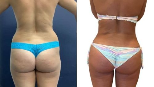 BBL—Brazilian butt lift