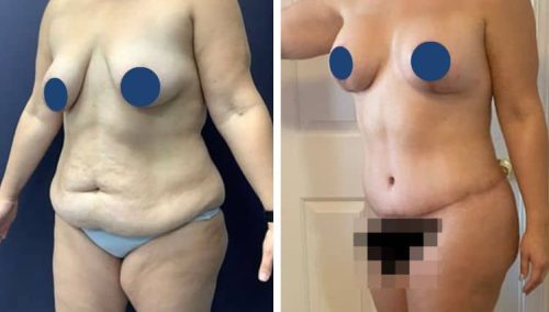 BREAST LIFT
