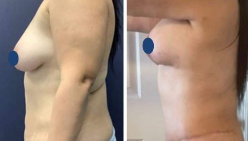 BREAST LIFT