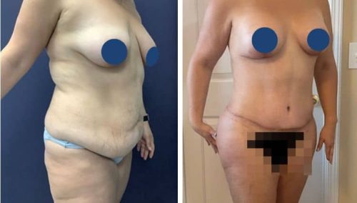 BREAST LIFT