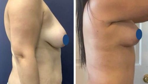 BREAST LIFT