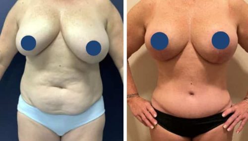 BREAST LIFT