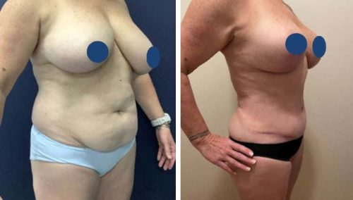 BREAST LIFT