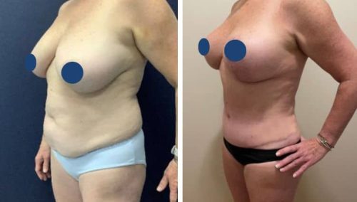BREAST LIFT