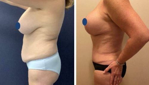 BREAST LIFT