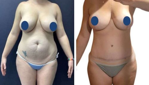 BREAST LIFT