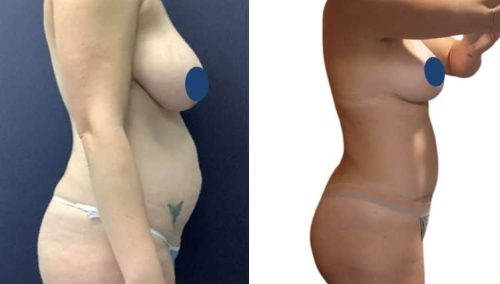 BREAST LIFT