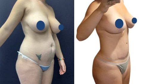 BREAST LIFT