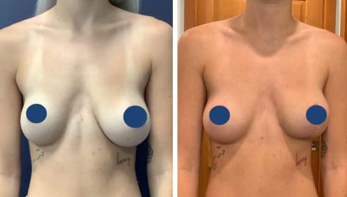 BREAST LIFT