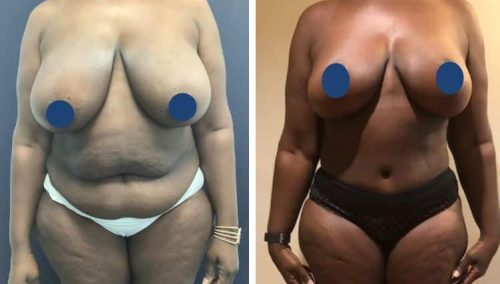 BREAST LIFT