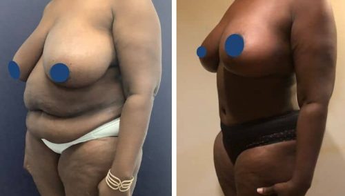 BREAST LIFT