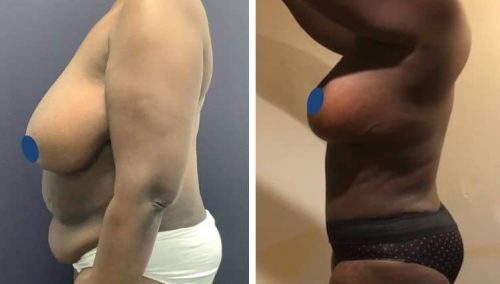 BREAST LIFT