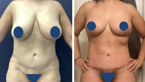 BREAST LIFT