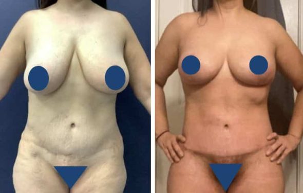 BREAST LIFT 772a BREAST LIFT IN COLOMBIA