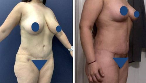 BREAST LIFT