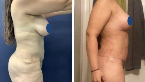 BREAST LIFT