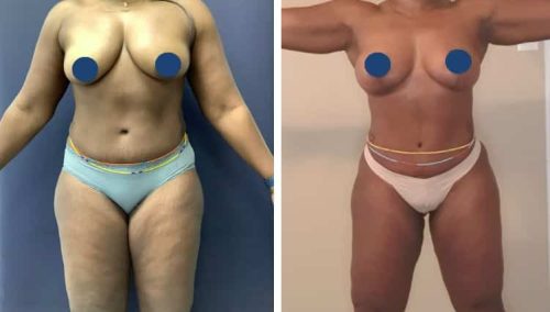 BREAST LIFT