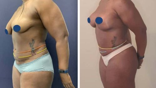 BREAST LIFT