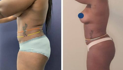 BREAST LIFT
