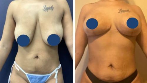 BREAST LIFT