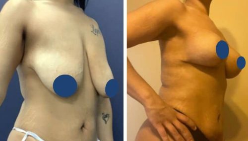 BREAST LIFT