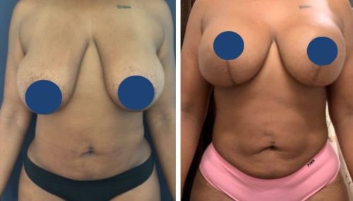 BREAST LIFT