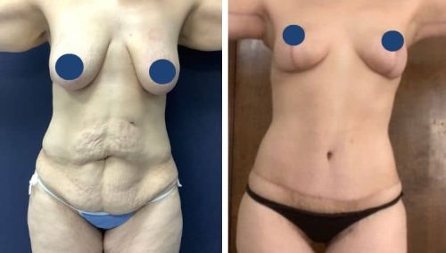 BREAST LIFT