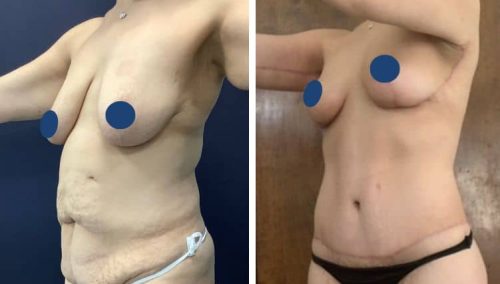 BREAST LIFT