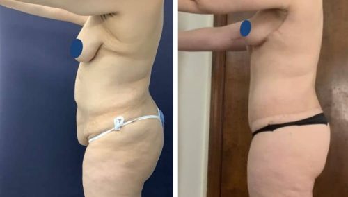 BREAST LIFT
