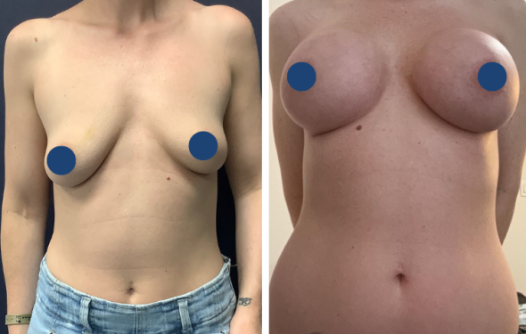 Breast Augmentation in Colombia