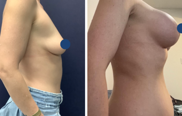 Breast Augmentation in Colombia