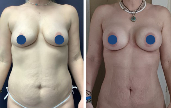 Breast Augmentation in Colombia