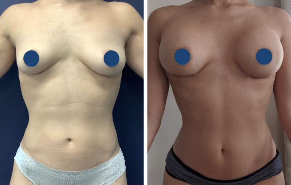 Breast Augmentation in Colombia