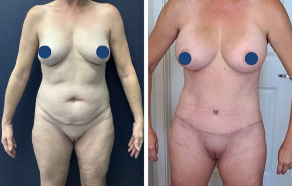 Breast Augmentation in Colombia