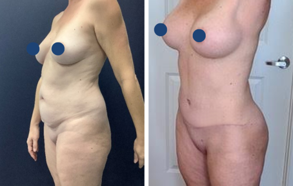 Breast Augmentation in Colombia