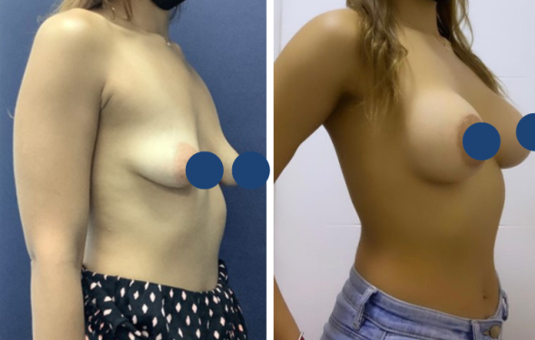 Breast Augmentation in Colombia